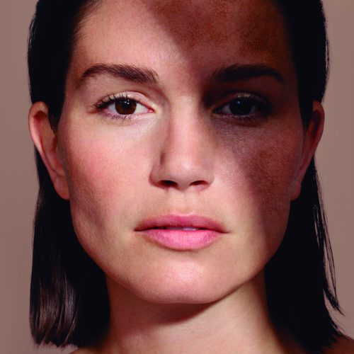 #akcjadepigmentacja z mesoestetic®. Jak skutecznie walczyć z problemem przebarwień skóry po lecie?